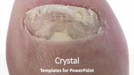  Presentation with nail - Slides having ringworm of the nail isolated background and a violet colored foreground