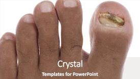  Presentation with nail - Audience pleasing theme consisting of ringworm of the nail backdrop and a tawny brown colored foreground