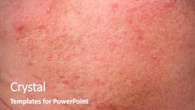  Presentation with skin disease - Amazing slide set having rosacea skin disease backdrop and a coral colored foreground