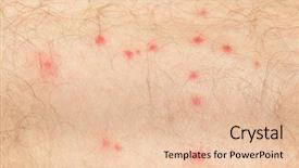  Presentation with mosquito - Amazing theme having scabs - detail of mosquito spot allergy backdrop and a lemonade colored foreground