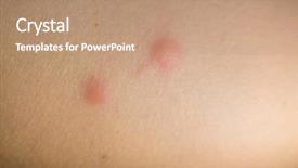  Presentation with insect - Cool new slides with scabs - insect bites on female hand backdrop and a coral colored foreground