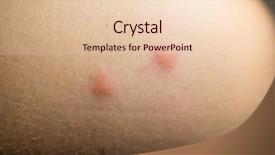  Presentation with insect animation - PPT layouts with scabs - insect bites on female hand background and a lemonade colored foreground