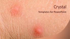  Presentation with allergy - Colorful presentation theme enhanced with scabs - macro of allergy pimples backdrop and a  colored foreground