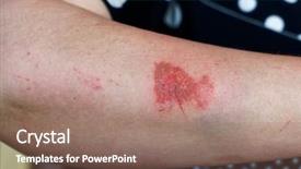  Presentation with trauma - PPT theme consisting of minor trauma due to fall background and a coral colored foreground