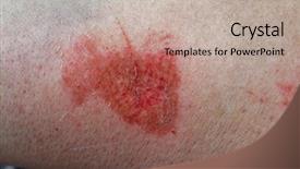  Presentation with skin - Presentation design consisting of scratched skin on woman's arm background and a mint green colored foreground