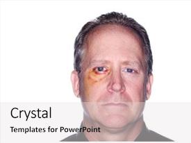 Eye Trauma Skin Abrasions PPT template 42 | CrystalGraphics