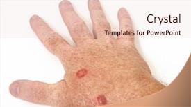  Presentation with cancer cells - Slide set having skin cancer - cryotherapy treatment to remove precancerous background and a lemonade colored foreground