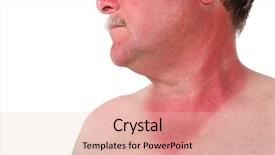  Presentation with skin cancer - Presentation theme having skin cancer - man with a sunburn background and a lemonade colored foreground