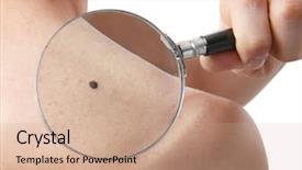  Presentation with skin cancer - Beautiful slide deck featuring skin cancer - young man with birthmarks backdrop and a coral colored foreground