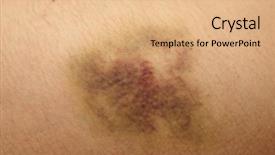  Presentation with hip - Theme consisting of skin disorders - nasty looking bruise on hip background and a coral colored foreground