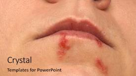  Presentation with skin infection - PPT layouts featuring skin infection - cold sores herpes labialis close-up background and a coral colored foreground