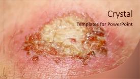  Presentation with simulation - Amazing presentation theme having skin infection - nasty looking bruise shot close-up backdrop and a coral colored foreground