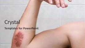  Presentation with wound - Slide deck enhanced with skin infection - scraped elbow - 5 days background and a soft green colored foreground