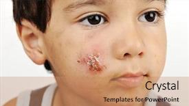  Presentation with skin infection - Beautiful PPT theme featuring skin infection - sick kid boy backdrop and a coral colored foreground