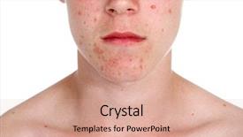  Presentation with acne - Presentation theme consisting of skin infection - teenager with acne background and a coral colored foreground