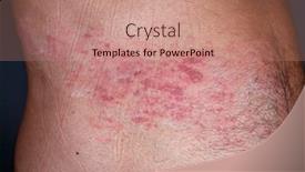  Presentation with varicella zoster virus - PPT layouts enhanced with skin-lesion-symptom-in-shingles background and a coral colored foreground