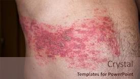  Presentation with varicella zoster virus - PPT theme consisting of skin-lesion-symptom-in-shingles background and a coral colored foreground