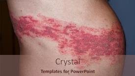  Presentation with varicella zoster virus - Theme having skin-lesion-symptom-in-shingles background and a coral colored foreground