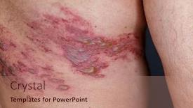  Presentation with varicella zoster virus - PPT theme consisting of skin-lesion-symptom-in-shingles background and a coral colored foreground
