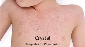  Presentation with skin - Colorful theme enhanced with skin rash - allergic reaction child backdrop and a lemonade colored foreground