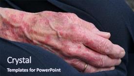  Presentation with psoriasis - Presentation enhanced with skin rash - extreme psoriasis on the hand background and a navy blue colored foreground