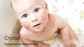  Presentation with dermatitis - Presentation design consisting of skin rash - little baby with dermatitis background and a coral colored foreground