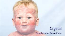  Presentation with dermatitis - Audience pleasing presentation theme consisting of skin rash - little baby with dermatitis backdrop and a sky blue colored foreground