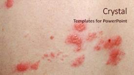  Presentation with roofing shingles - Audience pleasing slides consisting of skin rash - shingles sores backdrop and a lemonade colored foreground