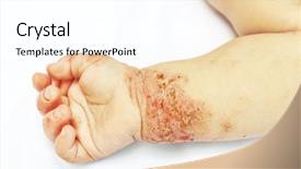  Presentation with woman covering man mouth hand - Colorful theme enhanced with skin rash - small hand of child covered backdrop and a white colored foreground