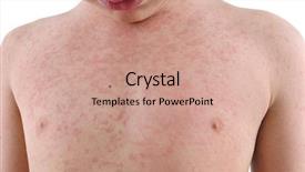  Presentation with body - Beautiful presentation theme featuring skin rash - urticaria on body backdrop and a coral colored foreground