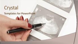  Presentation with ovary - Beautiful presentation theme featuring sonar - female doctor pointing backdrop and a lemonade colored foreground