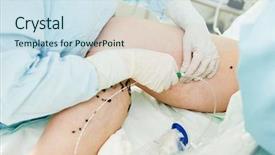  Presentation with vein - Presentation having surgeon performs varicose veins correction background and a sky blue colored foreground