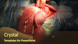  Presentation with uterus - PPT theme enhanced with surgeon removes the diseased uterus background and a tawny brown colored foreground