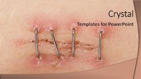  Presentation with laparoscopic surgery - Theme consisting of surgery incisions for a laparoscopic background and a lemonade colored foreground