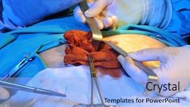  Presentation with surgery - Presentation theme enhanced with suture - closeup of a medical team background and a light blue colored foreground
