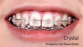  Presentation with health care - Colorful presentation theme enhanced with teeth with orthodontic brackets dental backdrop and a coral colored foreground