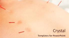  Presentation with acupuncture - Beautiful PPT theme featuring the first urinary bladder backdrop and a lemonade colored foreground