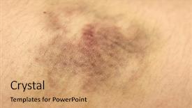  Presentation with insect macro of mosquito aedes - PPT theme consisting of tissue disorders - nasty looking bruise macro not background and a  colored foreground