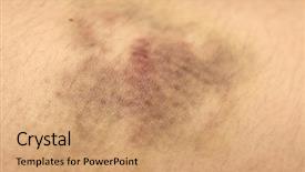  Presentation with shot - Colorful slides enhanced with tissue disorders - nasty looking bruise macro shot backdrop and a  colored foreground