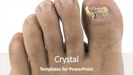 Presentation with fungus - Cool new theme with toenail suffering from fungus infection backdrop and a coral colored foreground