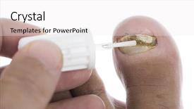  Presentation with fungus - Amazing slide set having toenail suffering fungus infection backdrop and a white colored foreground