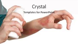  Presentation with spray - Audience pleasing PPT layouts consisting of treatment of burns by spray backdrop and a sky blue colored foreground