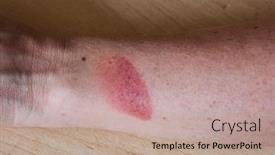  Presentation with treatment - PPT theme having treatment of burns on female hand on white background and a coral colored foreground