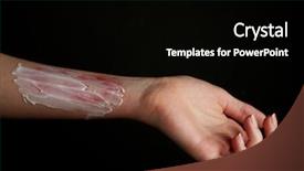  Presentation with black female - Beautiful slides featuring treatment of burns on female backdrop and a black colored foreground