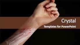  Presentation with burn - Slide deck consisting of treatment of burns on female background and a red colored foreground