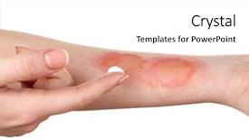  Presentation with treatment - PPT layouts with treatment of burns on female background and a white colored foreground
