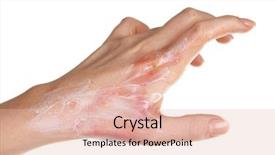  Presentation with treatment - PPT layouts featuring treatment of burns on female background and a lemonade colored foreground