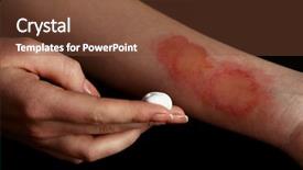  Presentation with black female - Beautiful slides featuring treatment of burns on female backdrop and a tawny brown colored foreground