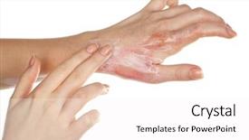  Presentation with treatment - Beautiful PPT layouts featuring treatment of burns on female backdrop and a white colored foreground
