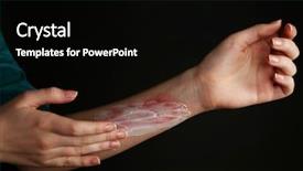  Presentation with burn - Presentation design featuring treatment of burns on female background and a black colored foreground